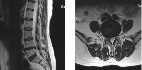 你的腰椎ct显示:腰椎退行性变是怎么回事?