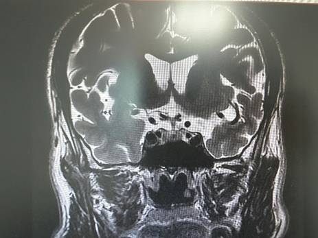 图2. 垂体mri t2wi示混杂信号,可见低信号结节