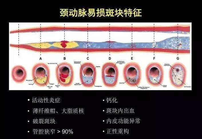 颈动脉斑块的危险,如何判断?