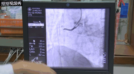 社会 正文  ▲患者欧伯 欧伯入院后,医生通过心血管造影,发现他的心脏