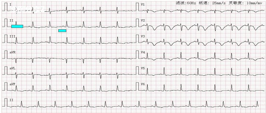 患者溶栓前心电图:典型siqⅢtⅢ征,icrbbb(不完全性右束支传导阻滞),t