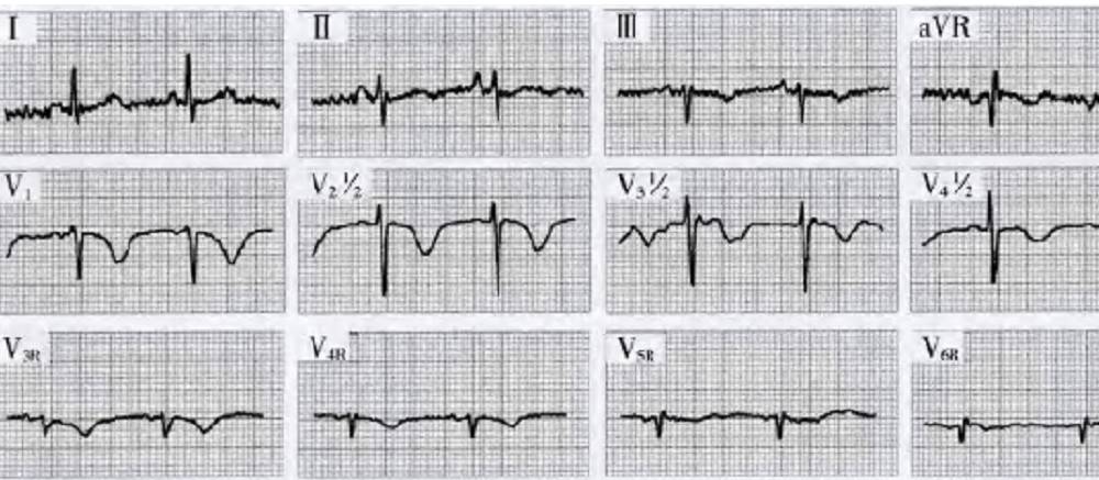 急性肺栓塞的心电图该怎么看专家来支招