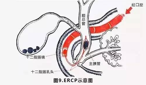 7,ercp是什么?