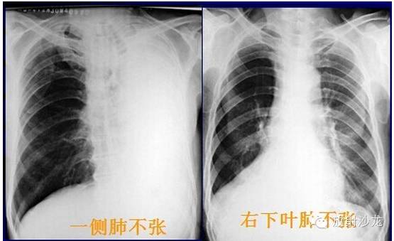 健康 正文  ① 一侧肺不张:患侧肺野密度均匀增高,肋间隙变窄.