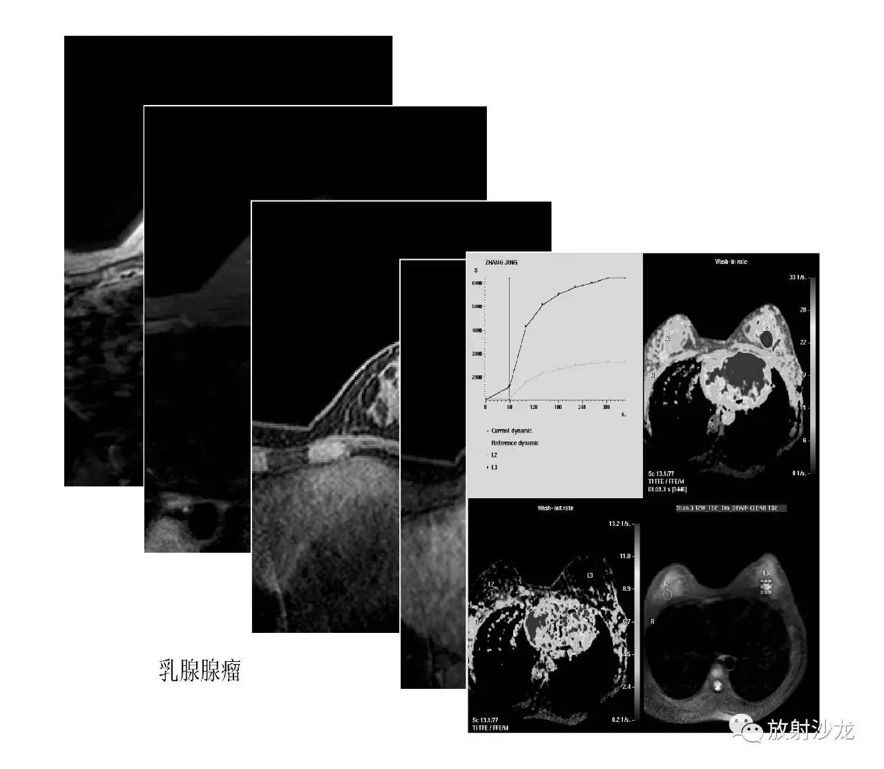 必收藏乳腺核磁扫描常规