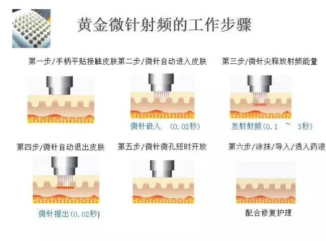 微针介导射频发射,避免了射频从表皮传导到真皮的能量损失,微针黄金