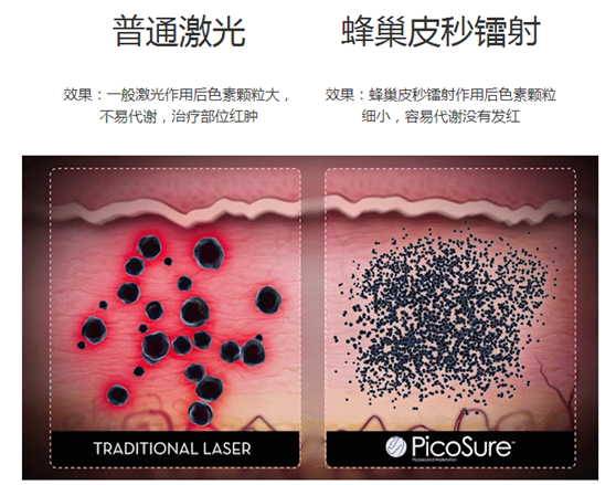 皮秒激光只针对黑色素细胞,不会影响正常的肌肤细胞,可以安全变美