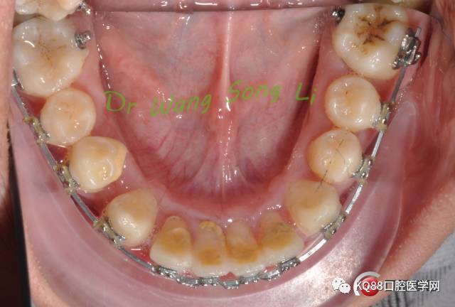 治疗方案:(拔除滞留乳牙,下颌扩弓同时配合改良式斜导 后牙区交互牵引