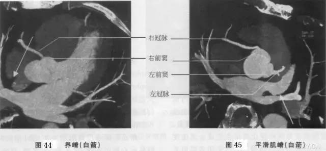 看懂心血管ct解剖只要10分钟