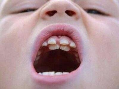 小孩子牙齿不齐一般是哪里出了问题