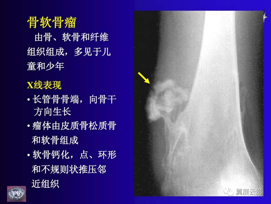 骨肿瘤ct和mri的影像表现