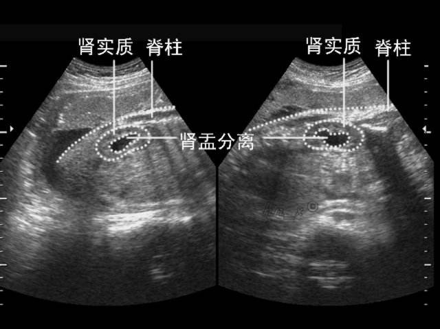 那么很多孕妈就有疑问了, 肾盂分离到底是什么意思呢?