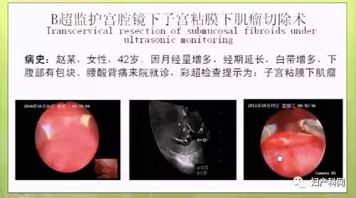 (三)b超监护宫腔镜下宫角妊娠残留物切除术