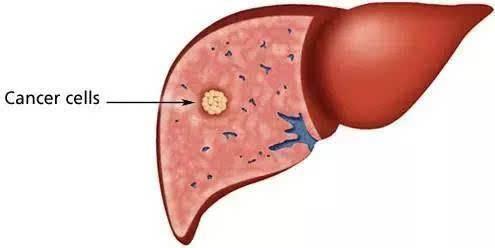 搜狐公众平台 - 南京早期肝硬化能治好吗
