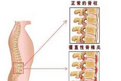 艾灸治好胆结石的原理_胆结石可怕吗 艾灸能把胆结石灸成泥沙状(3)