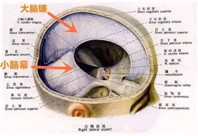 正常成年人脑袋里,有一些膜样组织(大脑镰,小脑幕),包裹,兜住脑组织