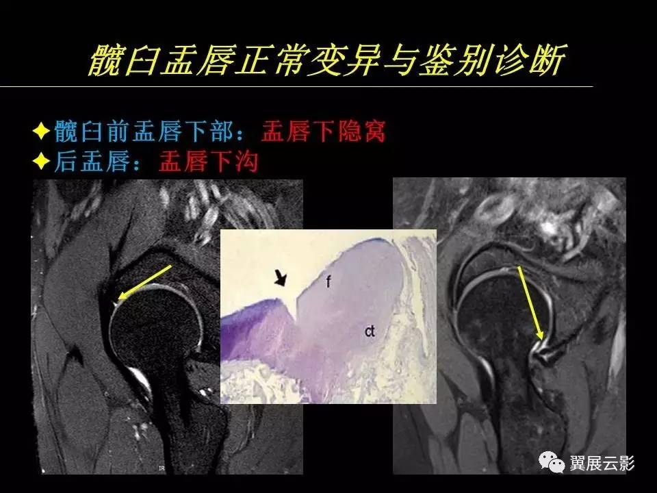 【专家课堂课后整理】髋关节撞击综合征和盂唇损伤的mr诊断