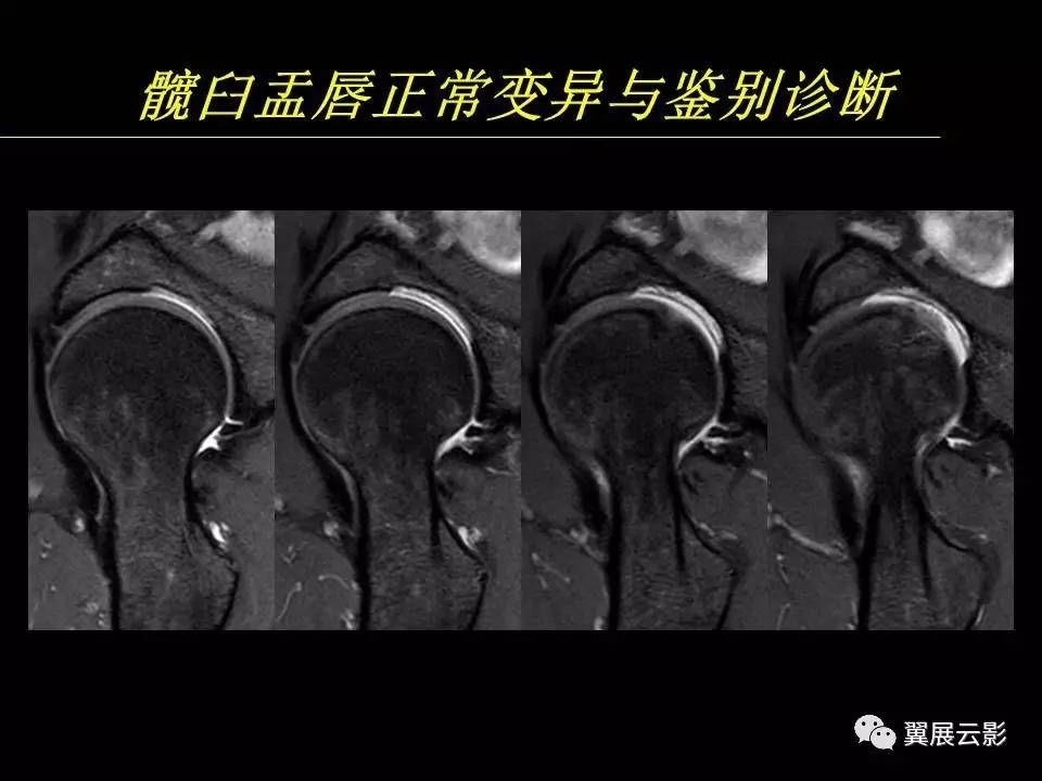 专家课堂课后整理髋关节撞击综合征和盂唇损伤的mr诊断