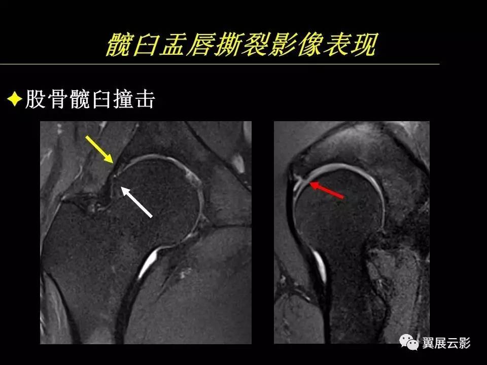 【专家课堂课后整理】髋关节撞击综合征和盂唇损伤的mr诊断