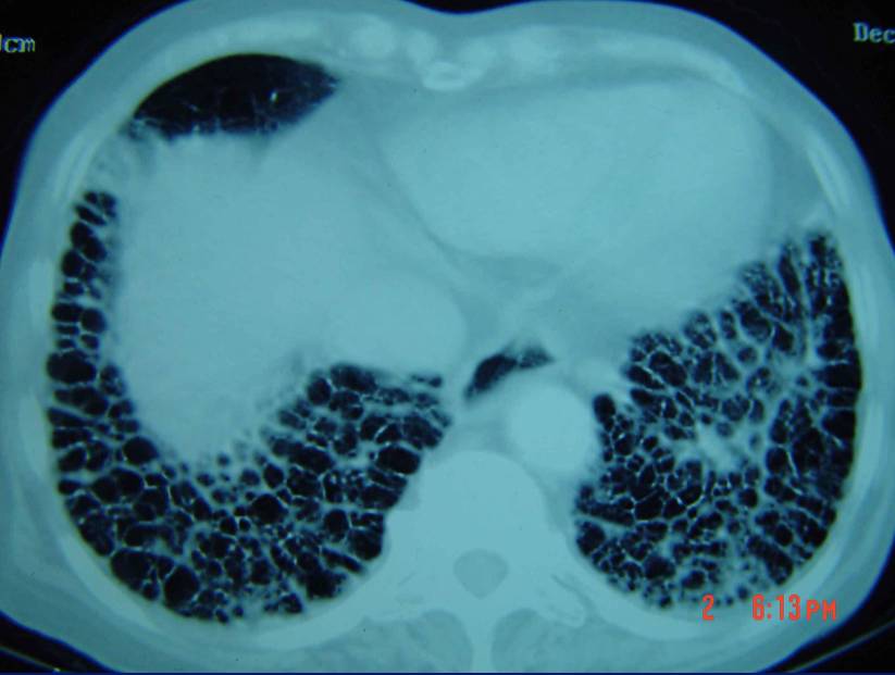普通型间质性肺炎(uip),见图2若ct表现以网状影和蜂窝肺为主,会是哪些