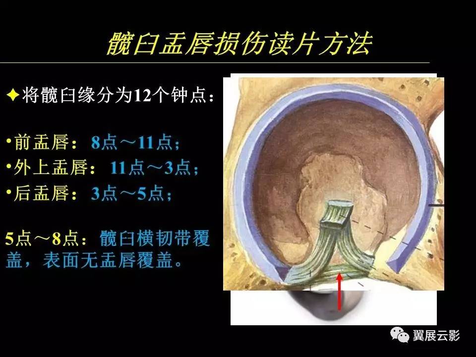 专家课堂课后整理髋关节撞击综合征和盂唇损伤的mr诊断