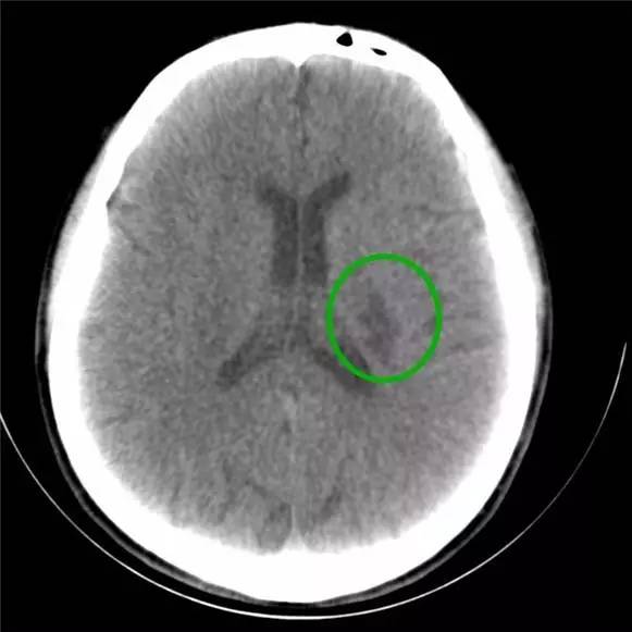 救护车载移动ct扫描脑出血后软化灶形成