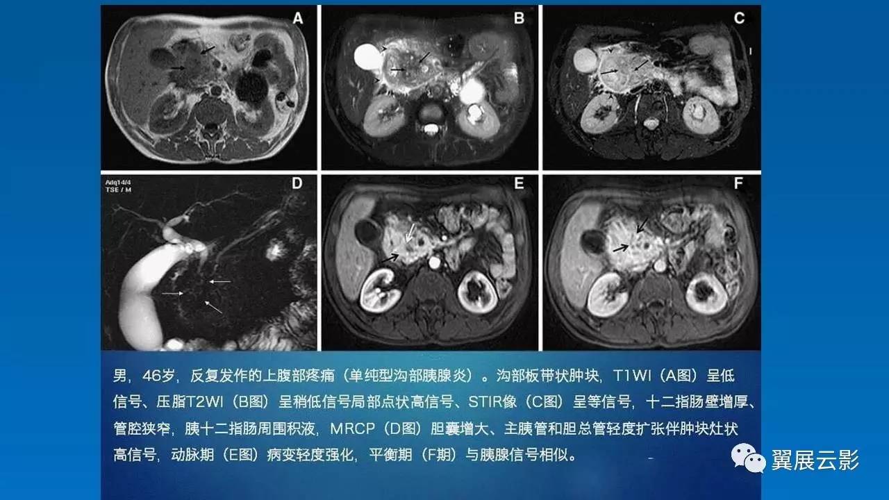 【优秀课堂课后整理】沟槽状胰腺炎的影像诊断