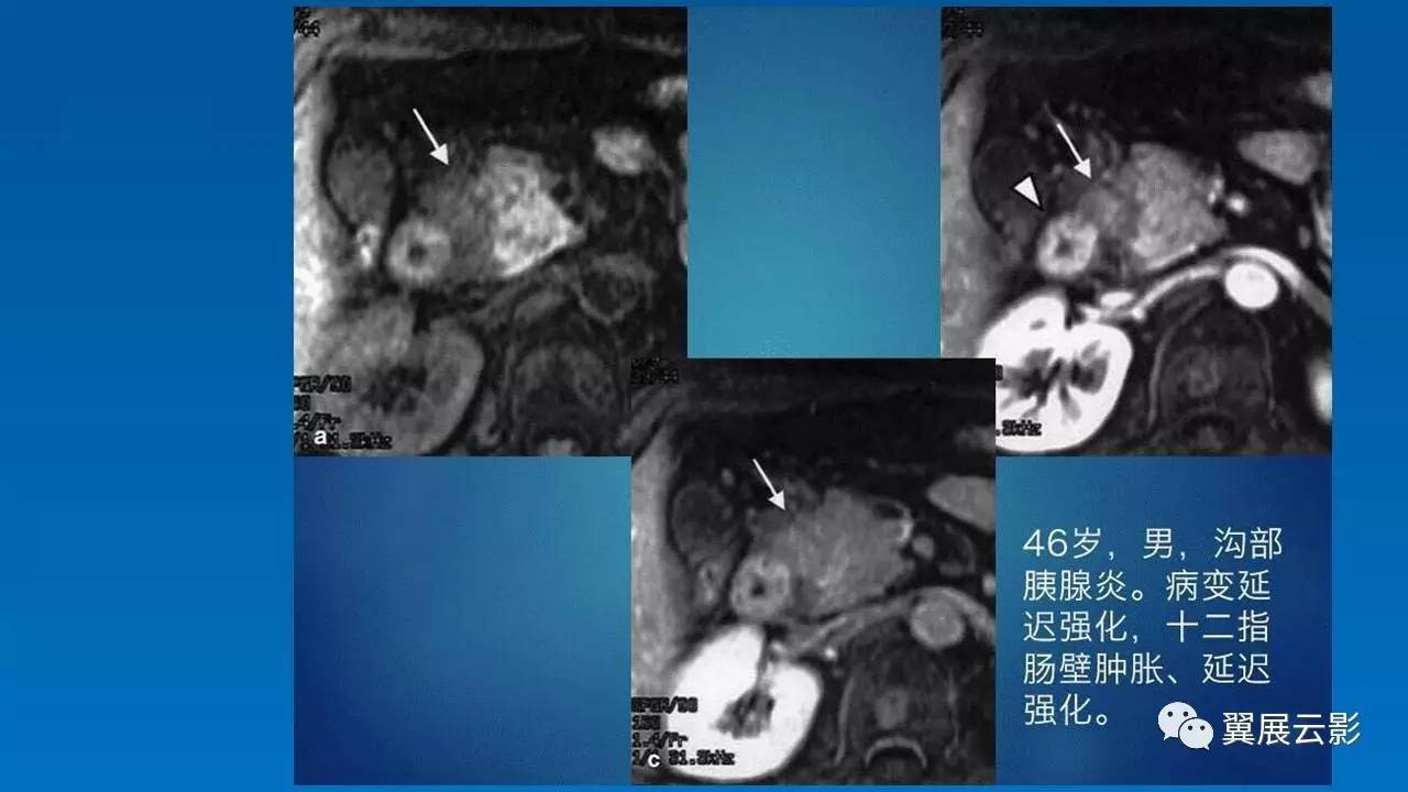 【优秀课堂课后整理】沟槽状胰腺炎的影像诊断