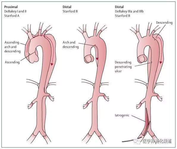 主动脉夹层分型示意图(图片来自参考文献18)主动脉夹层的临床表现
