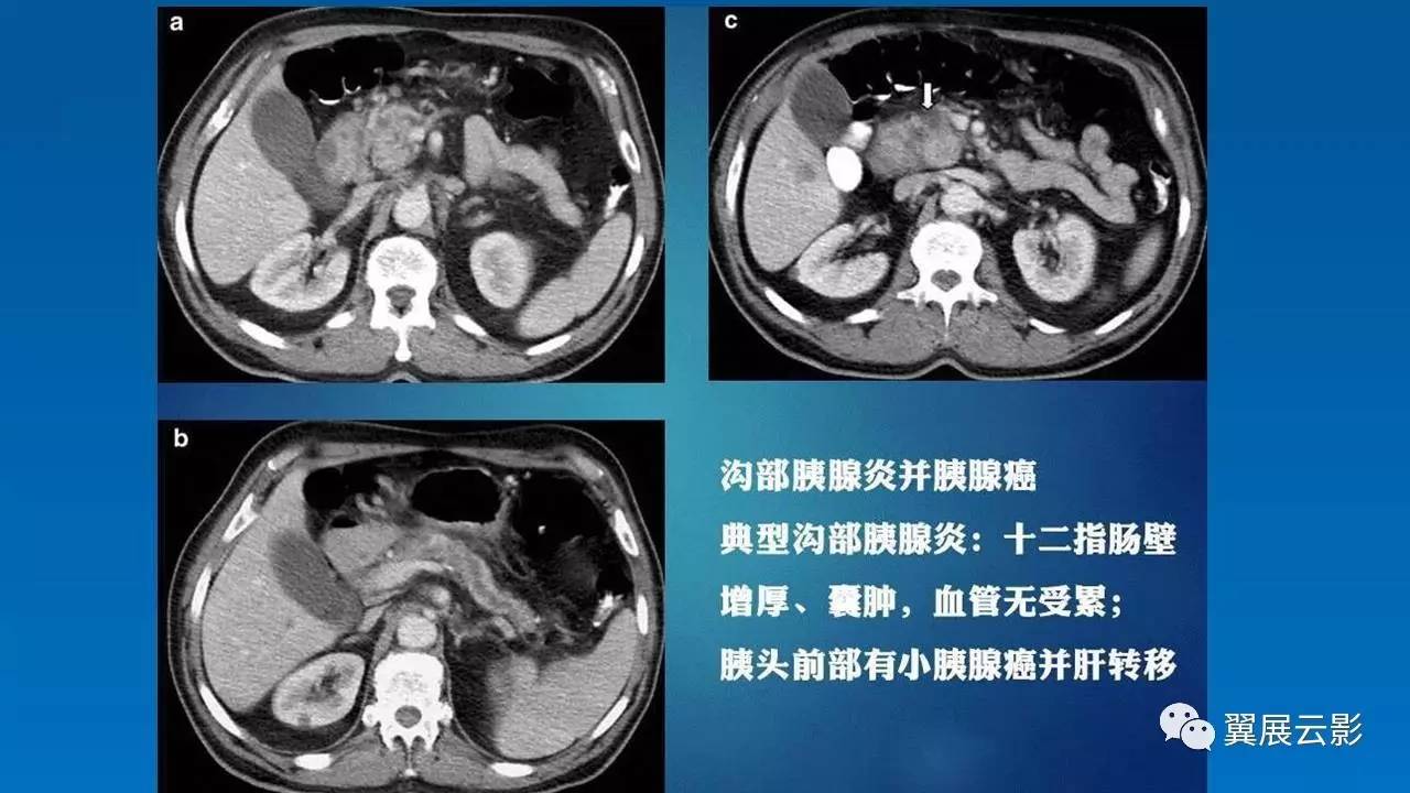 【优秀课堂课后整理】沟槽状胰腺炎的影像诊断