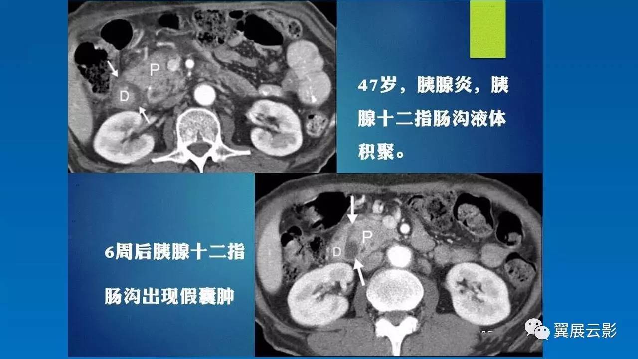 【优秀课堂课后整理】沟槽状胰腺炎的影像诊断