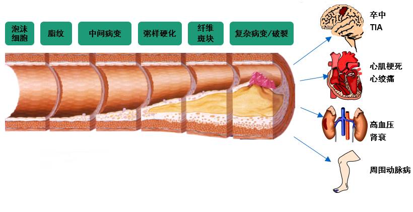 流行病学研究发现血脂异常是动脉粥样硬化性心血管疾病最重要的危险