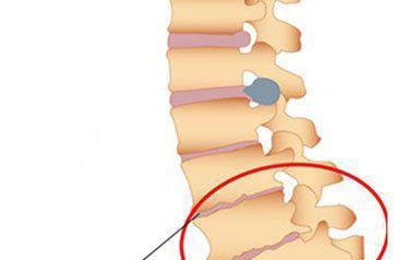 一,腰椎僵直:腰椎骨刺是长在椎体边缘部位,并且骨刺会随着刺激逐渐