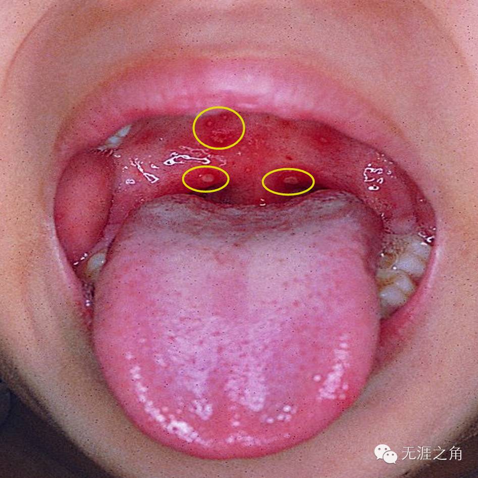 这些疱疹可出现在两颊部,硬腭,咽后壁,舌头,唇齿侧,偶尔还会出现在