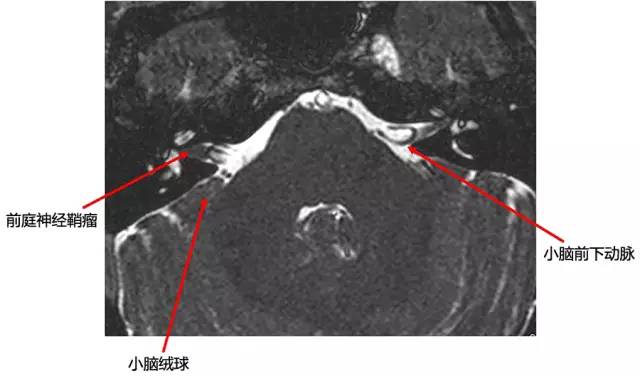 多图:桥小脑角区正常影像解剖及常见病变