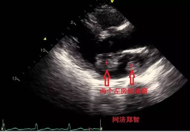 心脏粘液瘤  1. 左房粘液瘤  图一  图二 图三 图