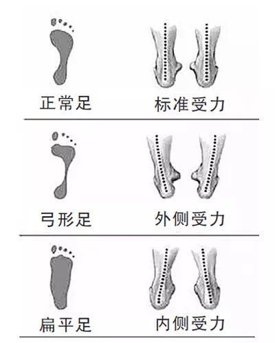 扁平足     扁平足走路时,脚底会过度向内旋转,由于频繁挤压,走多了