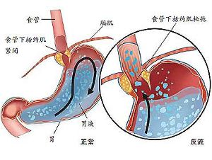 腹,三个狭窄要记住; 胃居剑下左上腹,二门二弯又三部; 贲门幽门大小弯