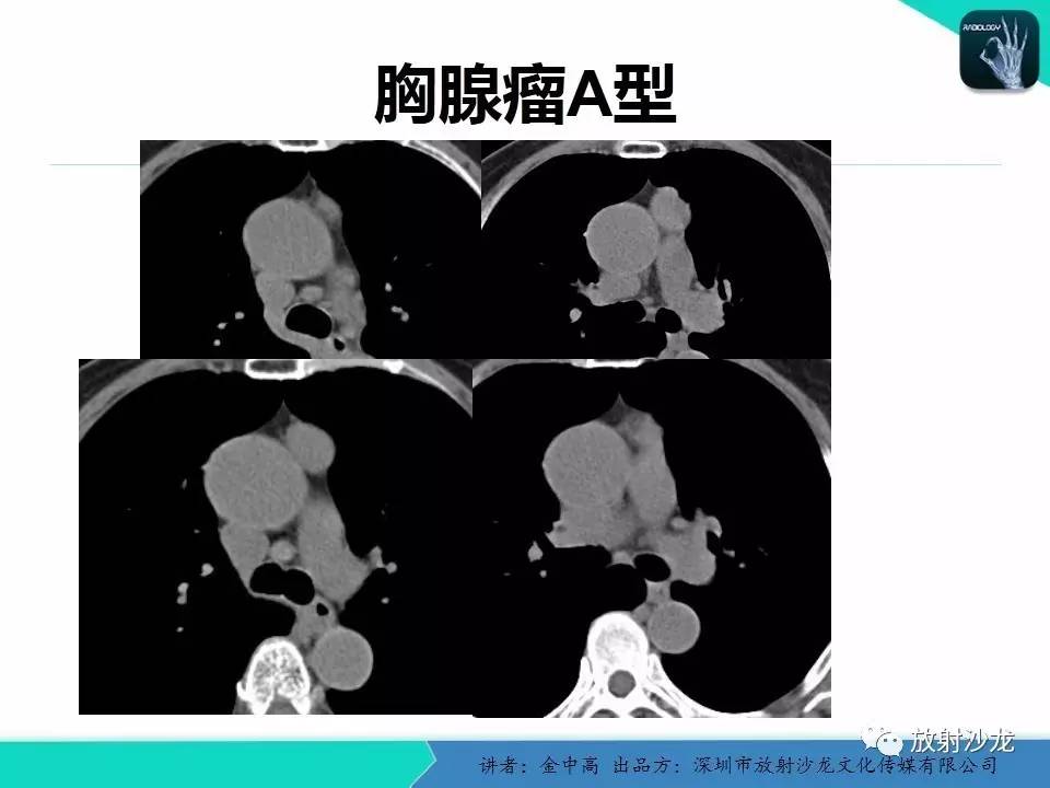 【专家大讲堂】ct对胸腺偶发结节的诊断和评价