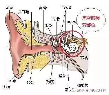 只有1 0%~1 5%的突聋患者在发病期间能够明确病因.