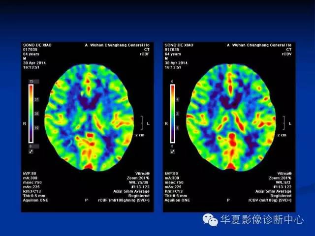 ct脑灌注原理及临床应用
