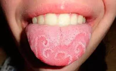 淡淡的舌苔全部消失,整个舌头通红,就像一块牛肉,这是萎缩性舌炎,或