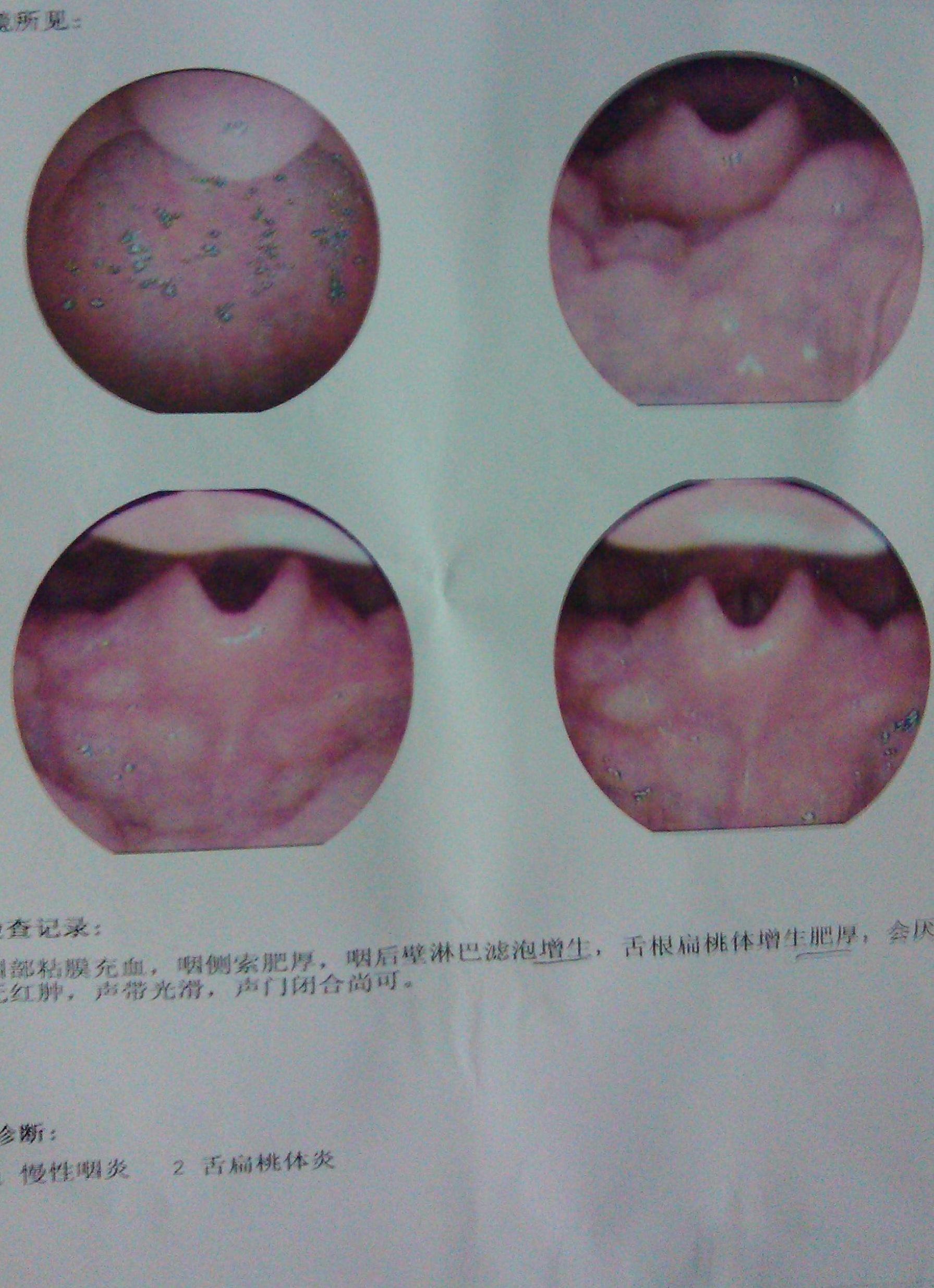 慢性咽炎偏方简单实用 慢性咽炎最怕三种水果 慢性咽炎舌根滤泡增生