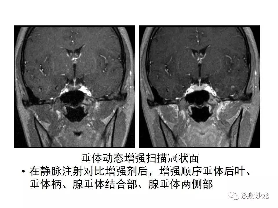 垂体瘤的mr诊断与鉴别诊断