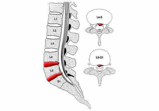 其中最常见的腰椎椎间盘突出l4—l5,l5-s1.