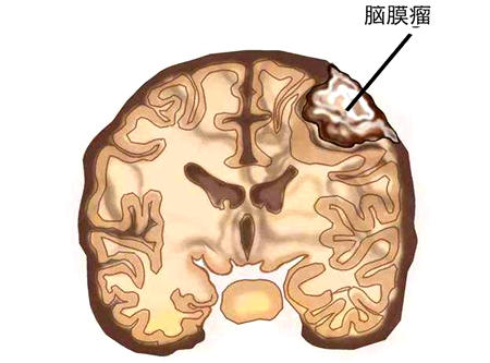 患者咨询:脑膜瘤最容易出现在哪里?