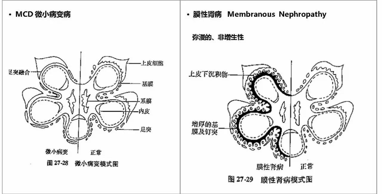 体 gn,其他都有 c3 沉积 缩写对照: 微小病变病 mcd 局灶节段硬化性肾