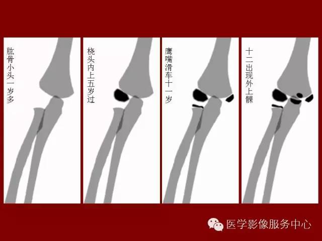 易误认为骨折的骨骺