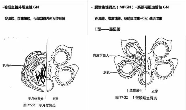 mcd 局灶节段硬化性肾小球肾炎 fsgn 膜性肾病 mn 系膜增生性肾小球