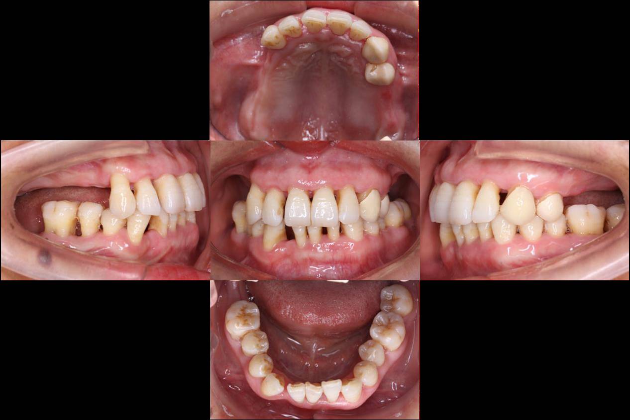 牙周手术后3个月,x线片显示21,23近中植骨区有高密度影形成 (3)正畸